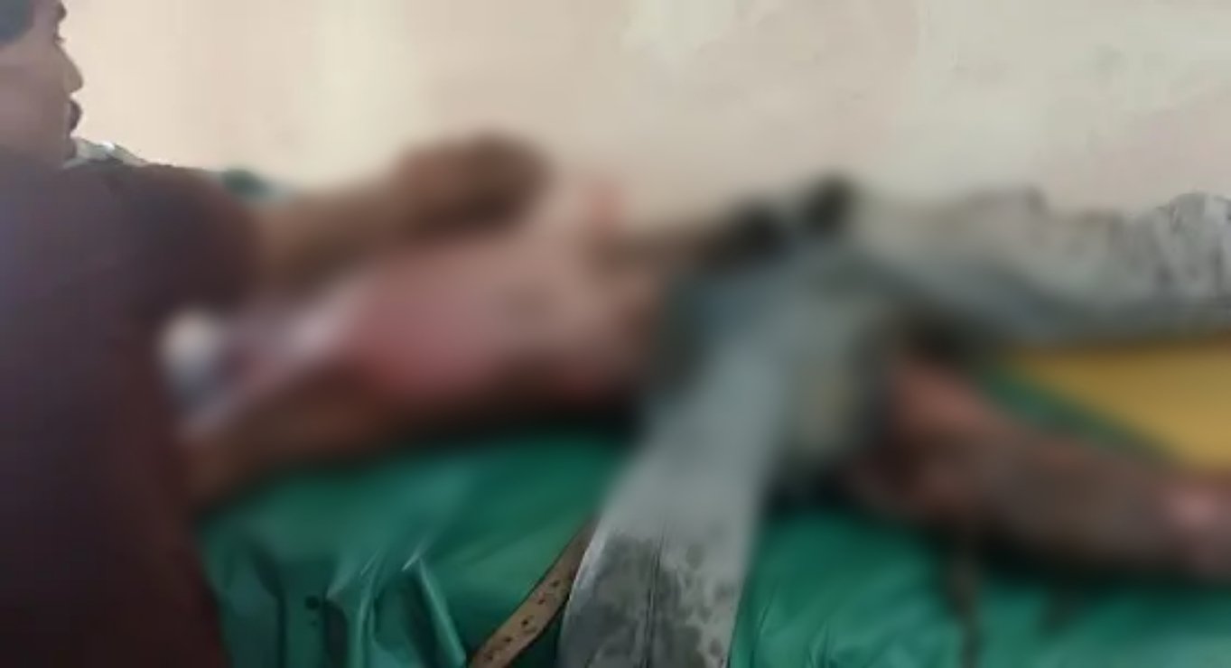 उरगा- ANP breaking news – कोयला निकालते वक्त मजदूर हाई वोल्टेज तार की चपेट में, हालत नाज़ुक 